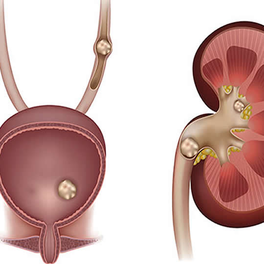 calculos renales en Quito