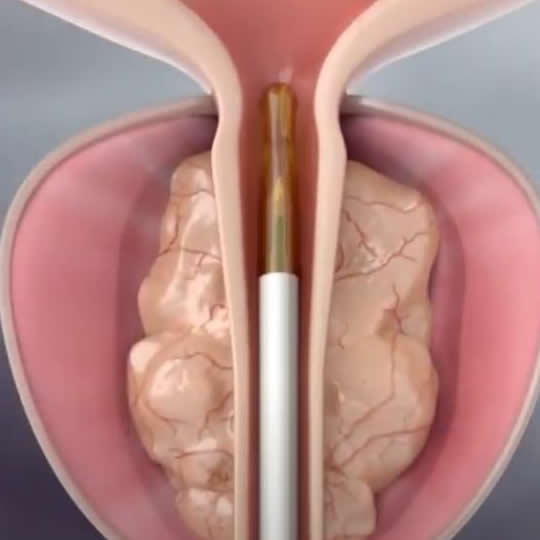 tratamiento de la próstata